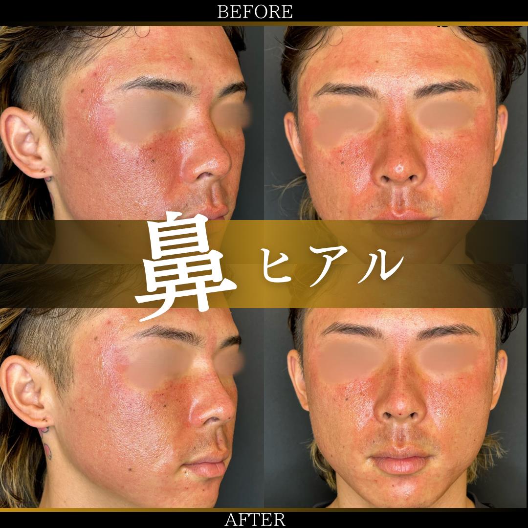 鼻ヒアルロン酸注入の症例写真
