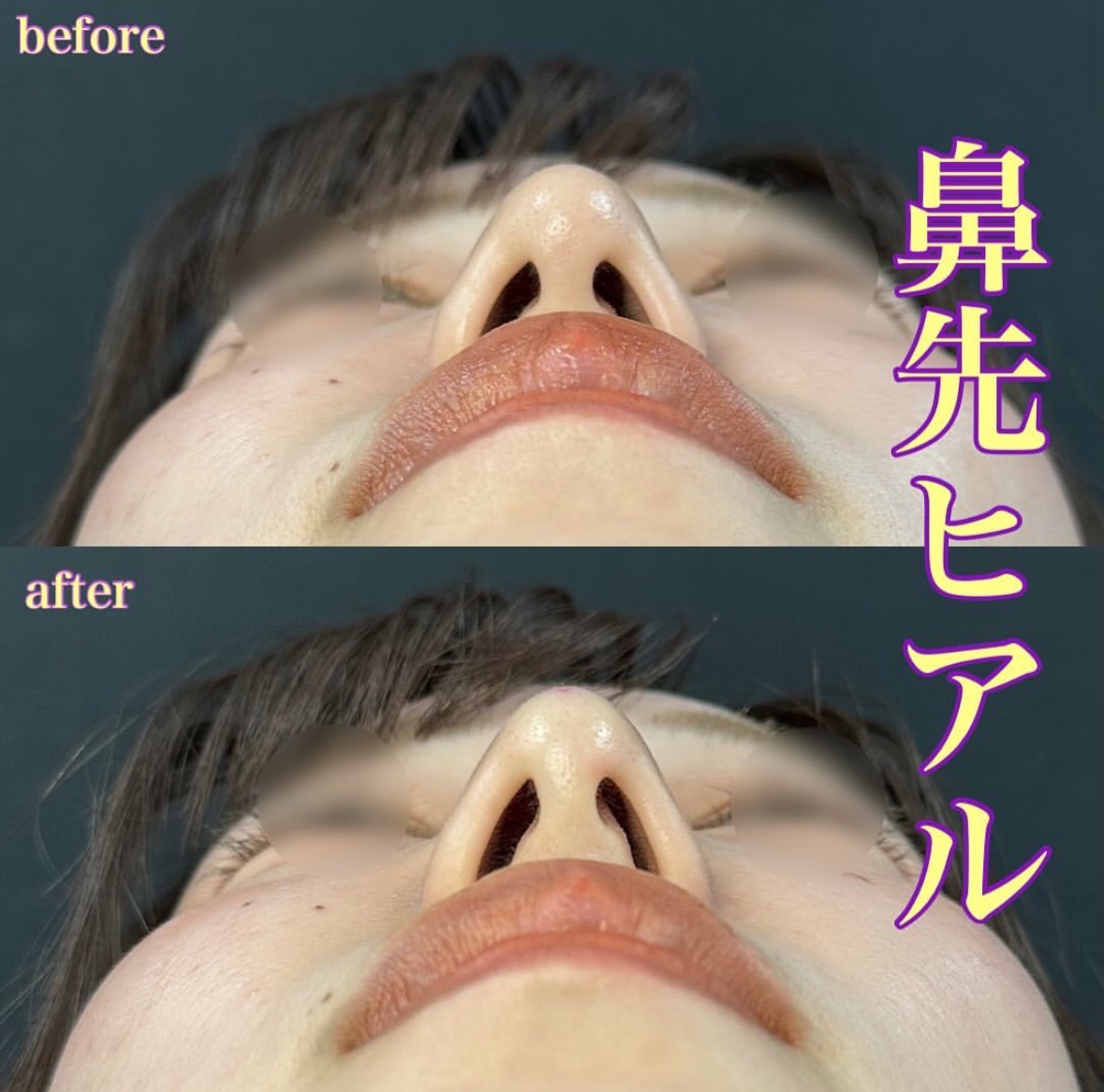 鼻ヒアルロン酸注入の症例写真