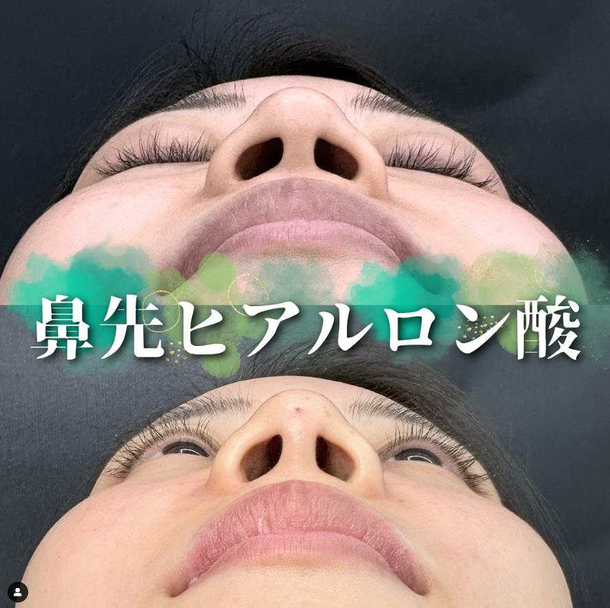 鼻ヒアルロン酸注入の症例写真