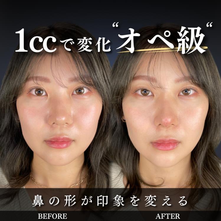 鼻ヒアルロン酸注入の症例写真