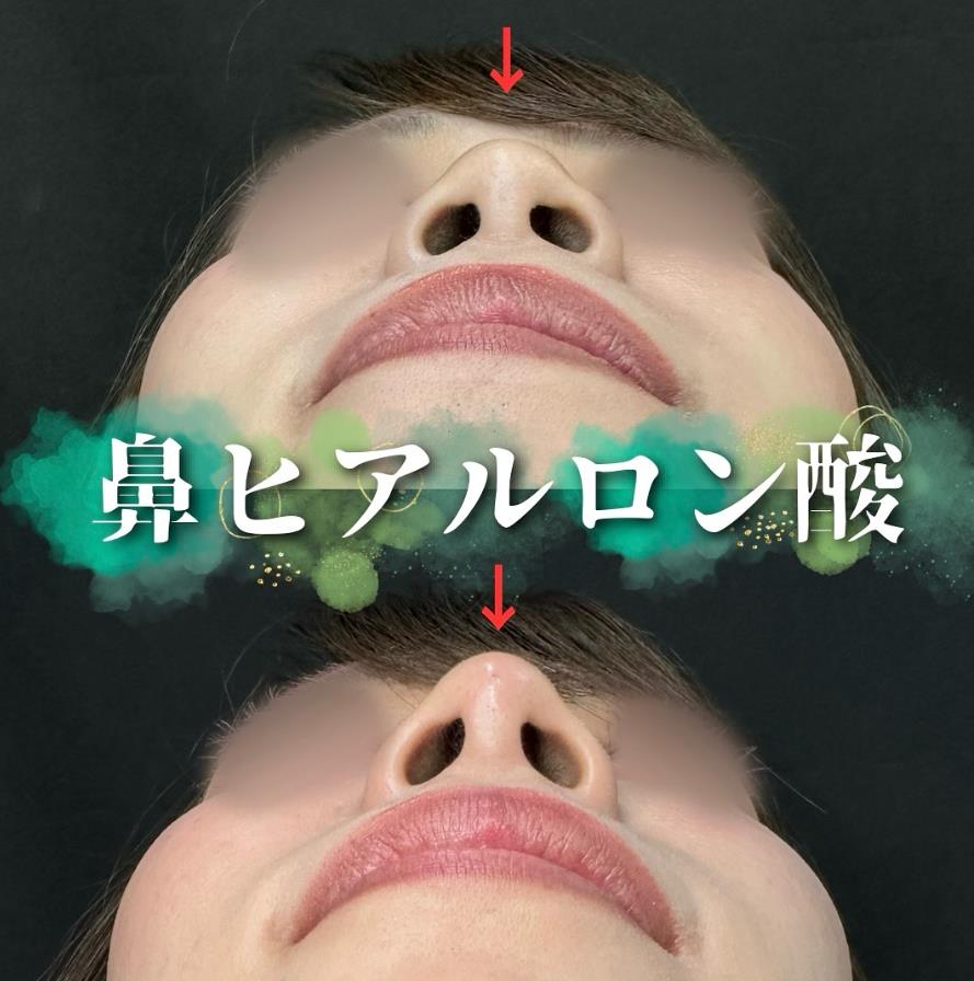 鼻ヒアルロン酸注入の症例写真
