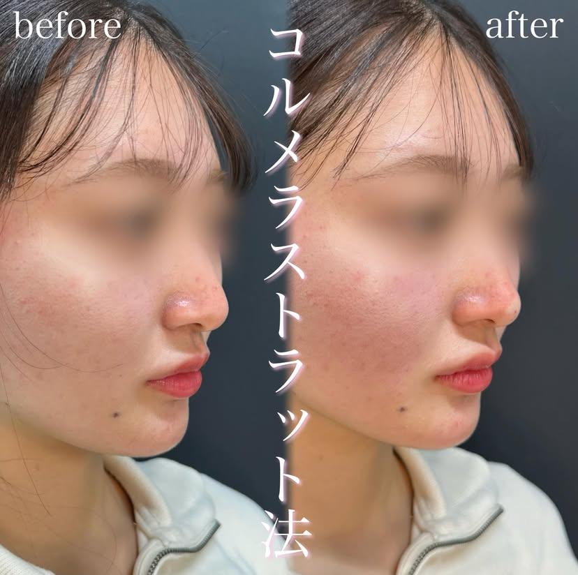 鼻ヒアルロン酸注入の症例写真