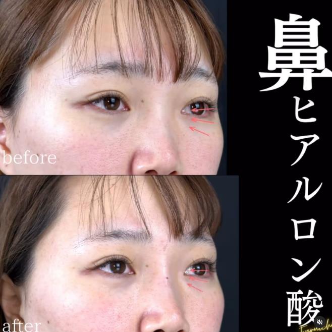 鼻ヒアルロン酸注入の症例写真