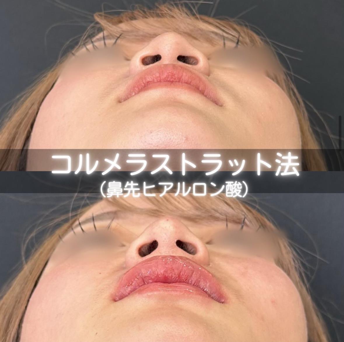 鼻ヒアルロン酸注入の症例写真