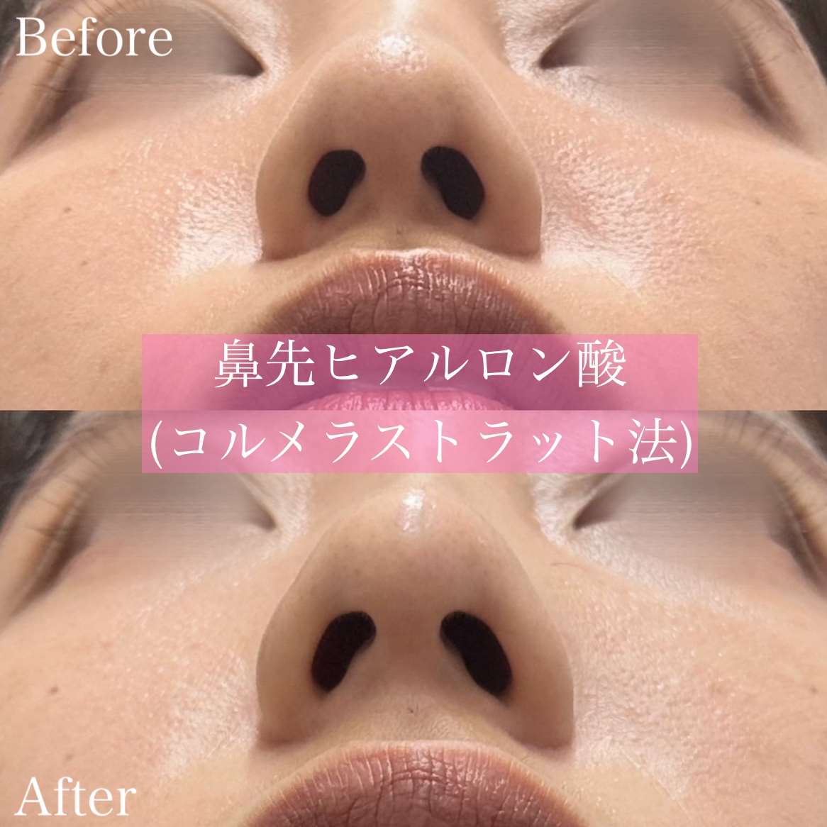 鼻ヒアルロン酸注入の症例写真