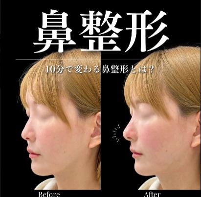鼻ヒアルロン酸注入の症例写真