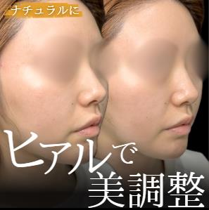 鼻ヒアルロン酸注入の症例写真