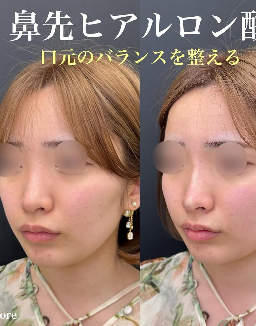 鼻ヒアルロン酸注入の症例写真