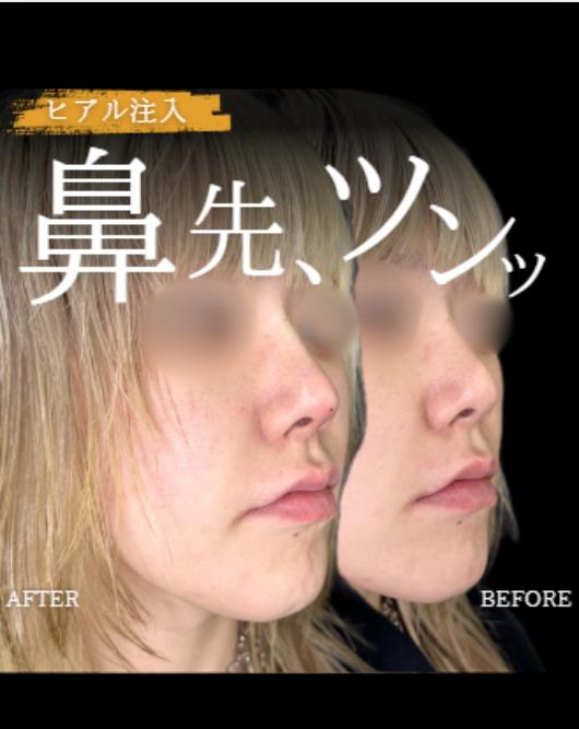 鼻ヒアルロン酸注入の症例写真
