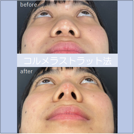 鼻ヒアルロン酸注入の症例写真