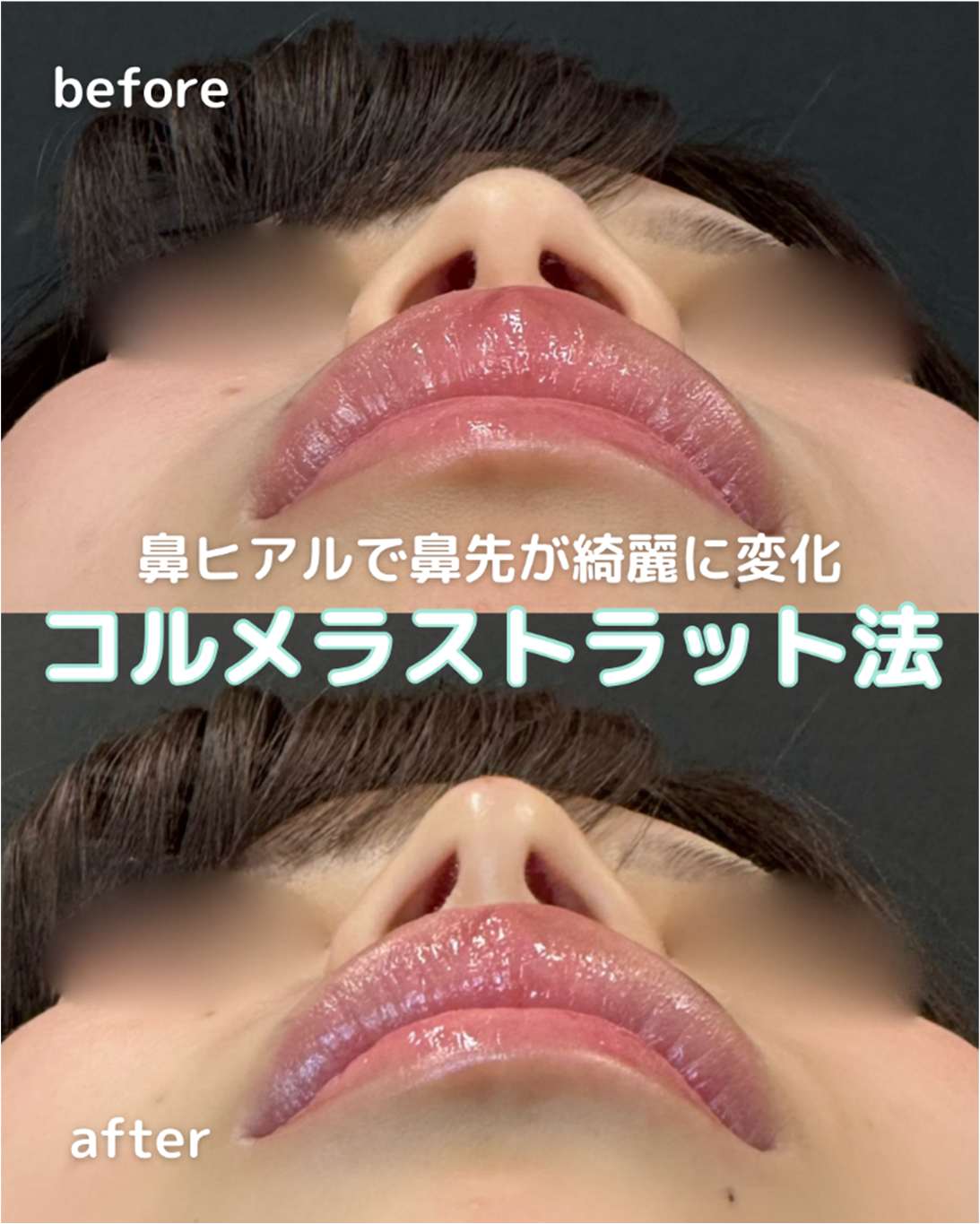 鼻ヒアルロン酸注入の症例写真