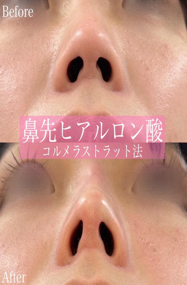 鼻ヒアルロン酸注入の症例写真