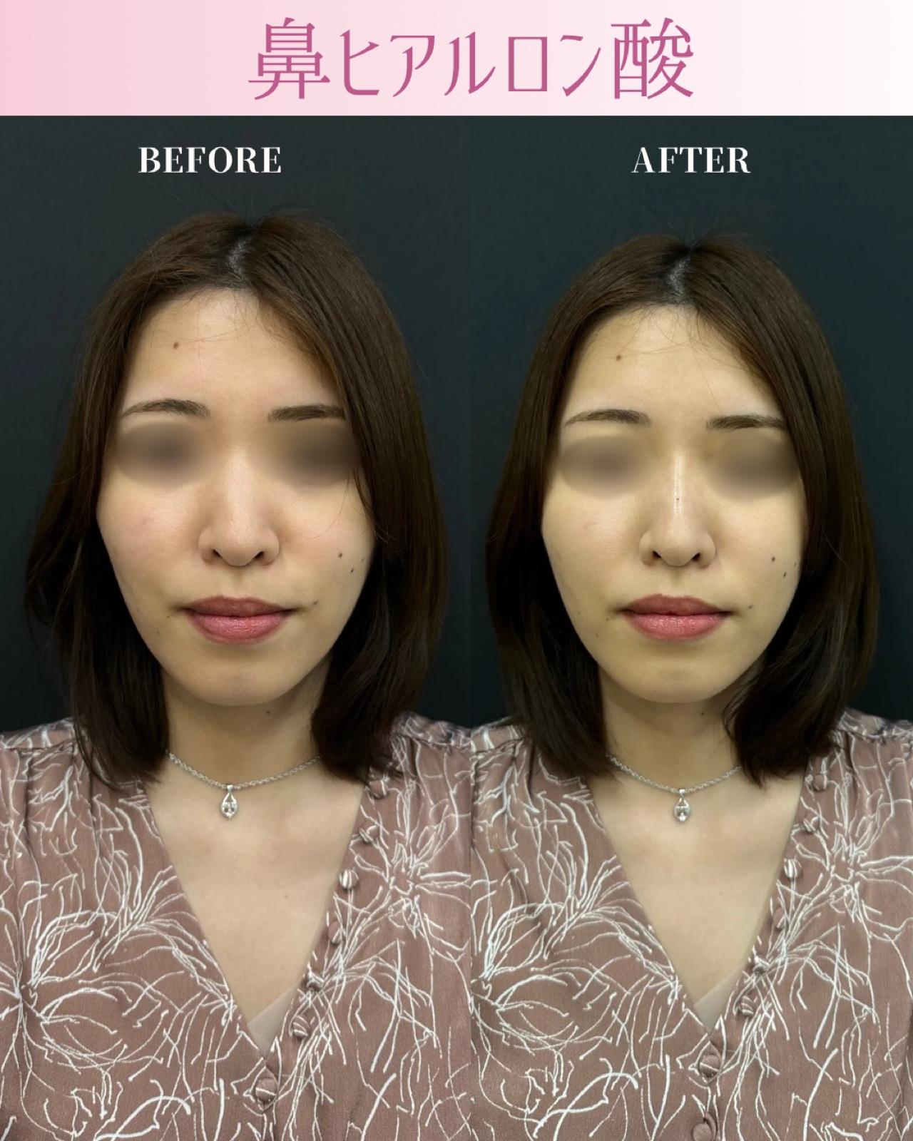 鼻ヒアルロン酸注入の症例写真