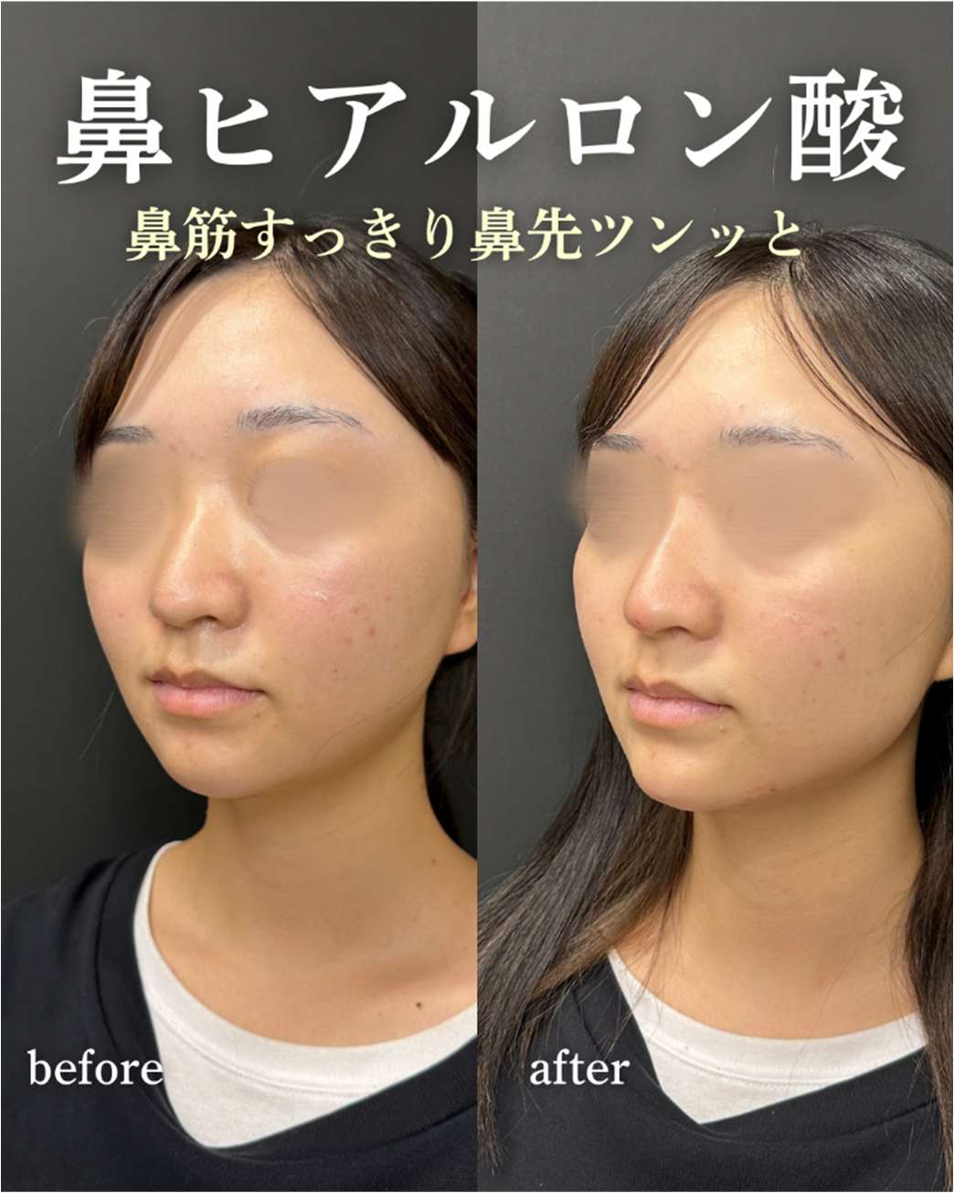 鼻ヒアルロン酸注入の症例写真