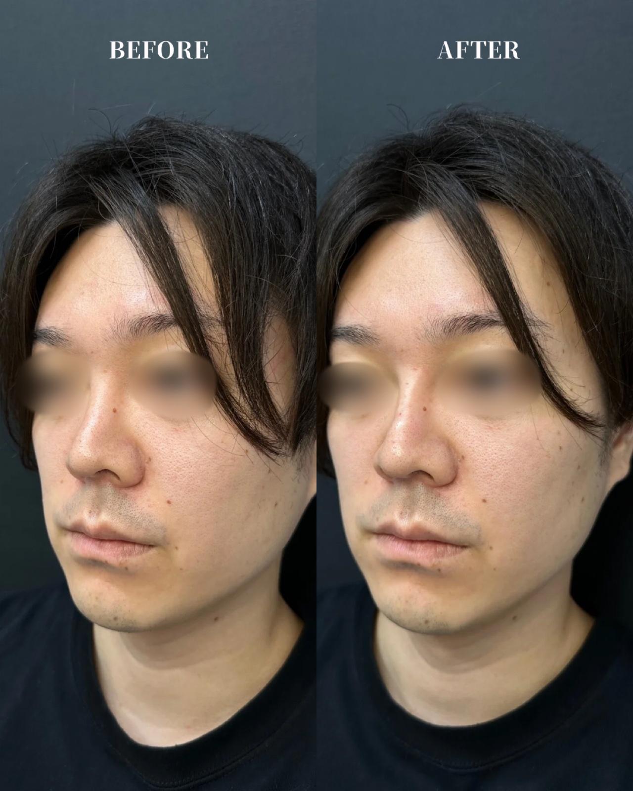 鼻ヒアルロン酸注入の症例写真