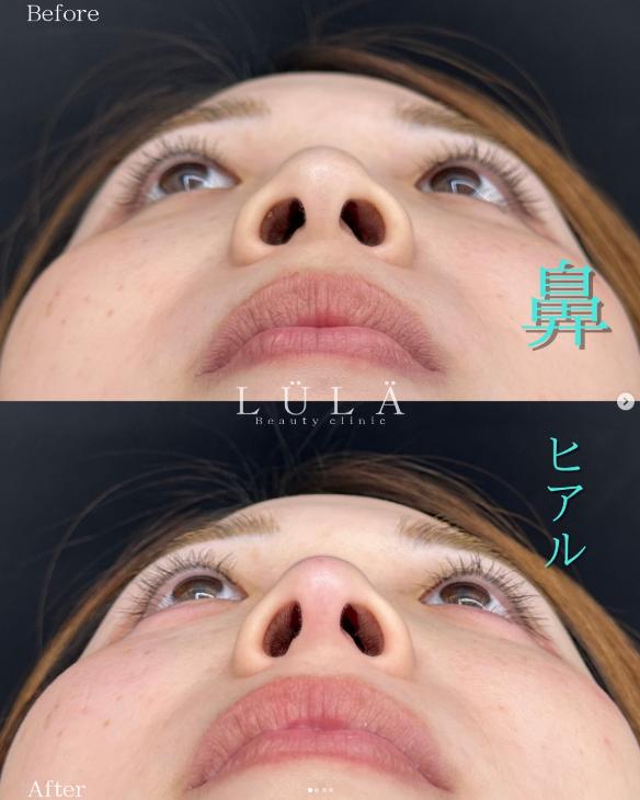 鼻ヒアルロン酸注入の症例写真