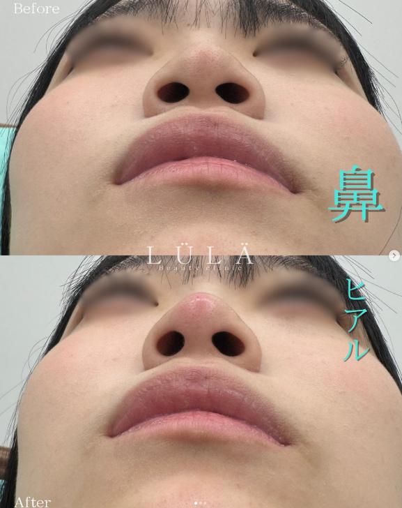 鼻ヒアルロン酸注入の症例写真