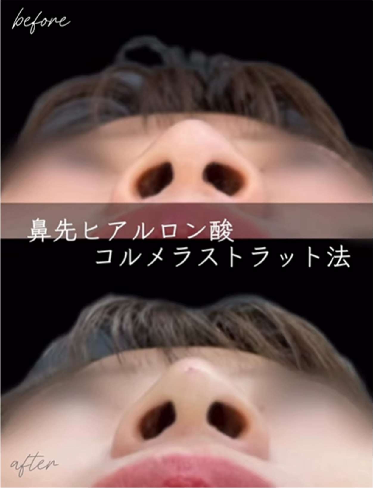 鼻ヒアルロン酸注入の症例写真