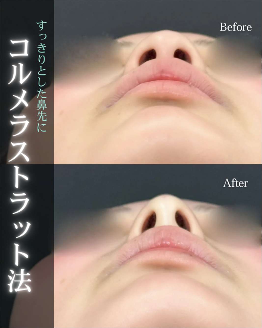 鼻ヒアルロン酸注入の症例写真