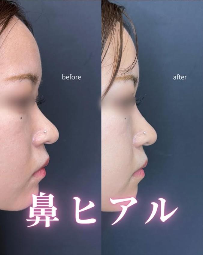 鼻ヒアルロン酸注入の症例写真