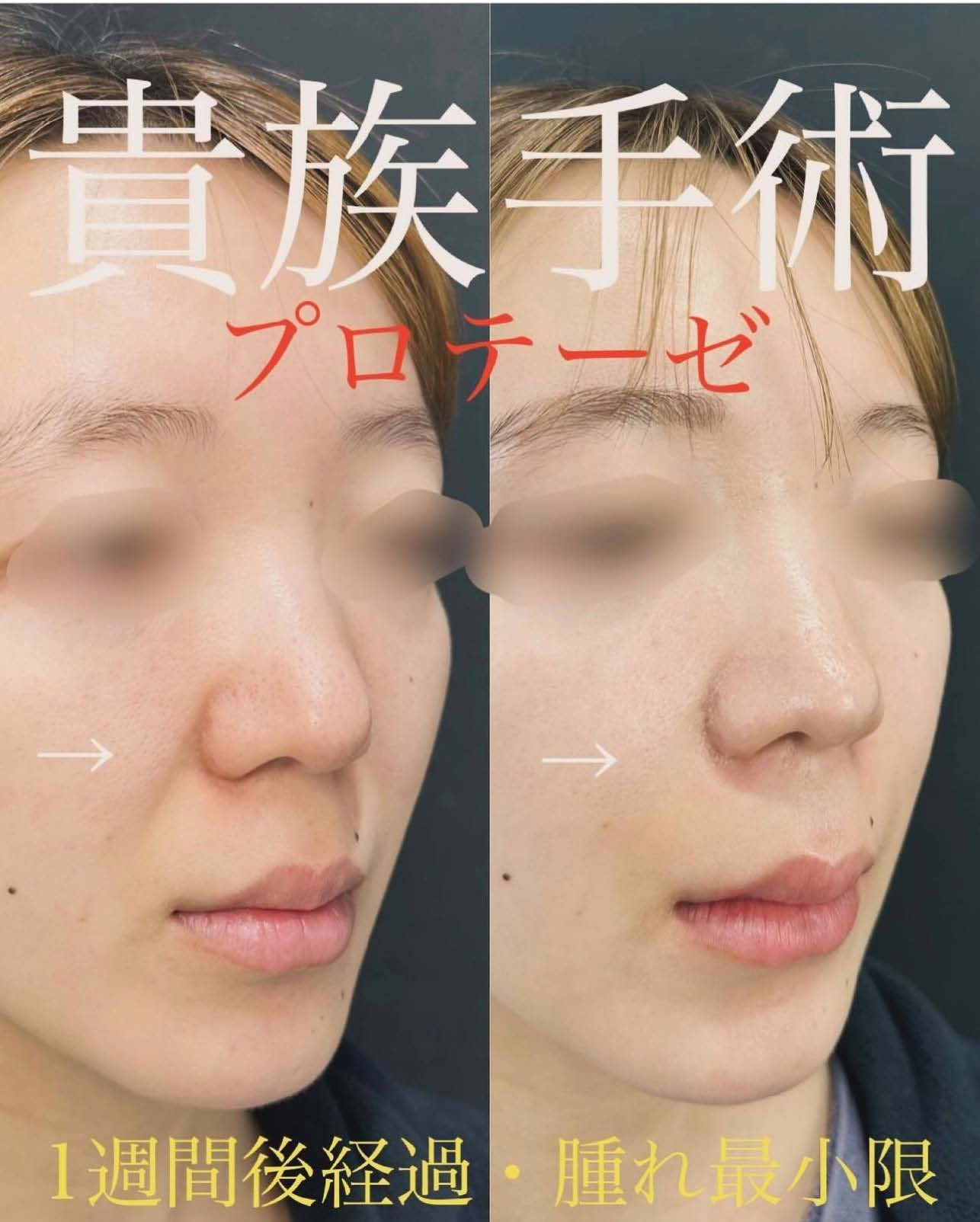 プロテーゼ隆鼻術の症例写真