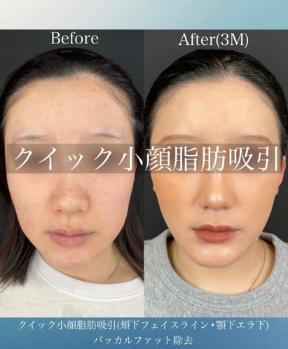 ルラ式クイック小顔脂肪吸引