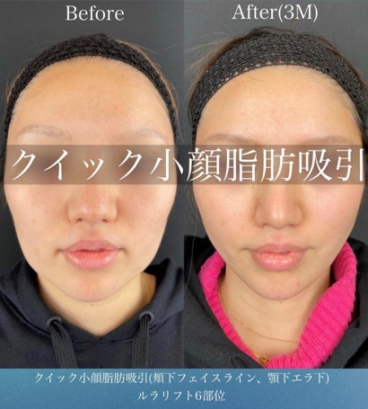 ルラ式クイック小顔脂肪吸引