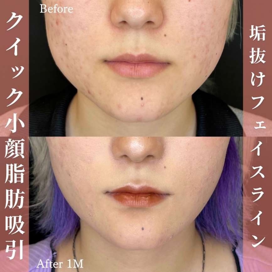 ルラ式クイック小顔脂肪吸引