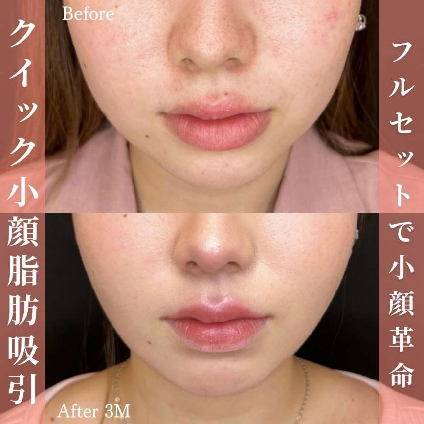 ルラ式クイック小顔脂肪吸引