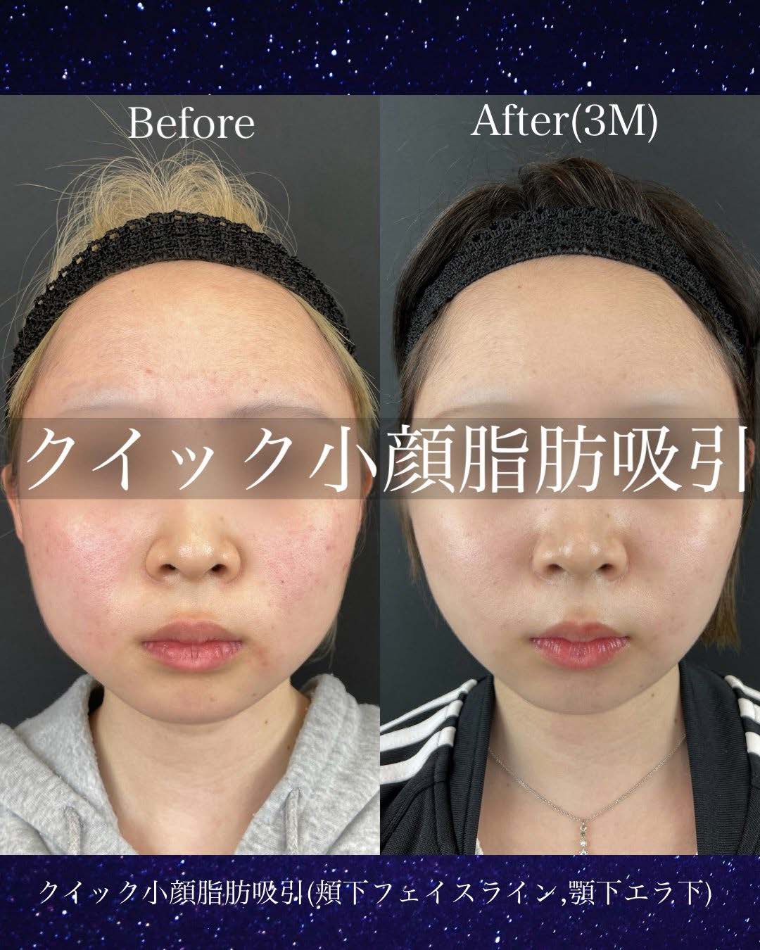 ルラ式クイック小顔脂肪吸引