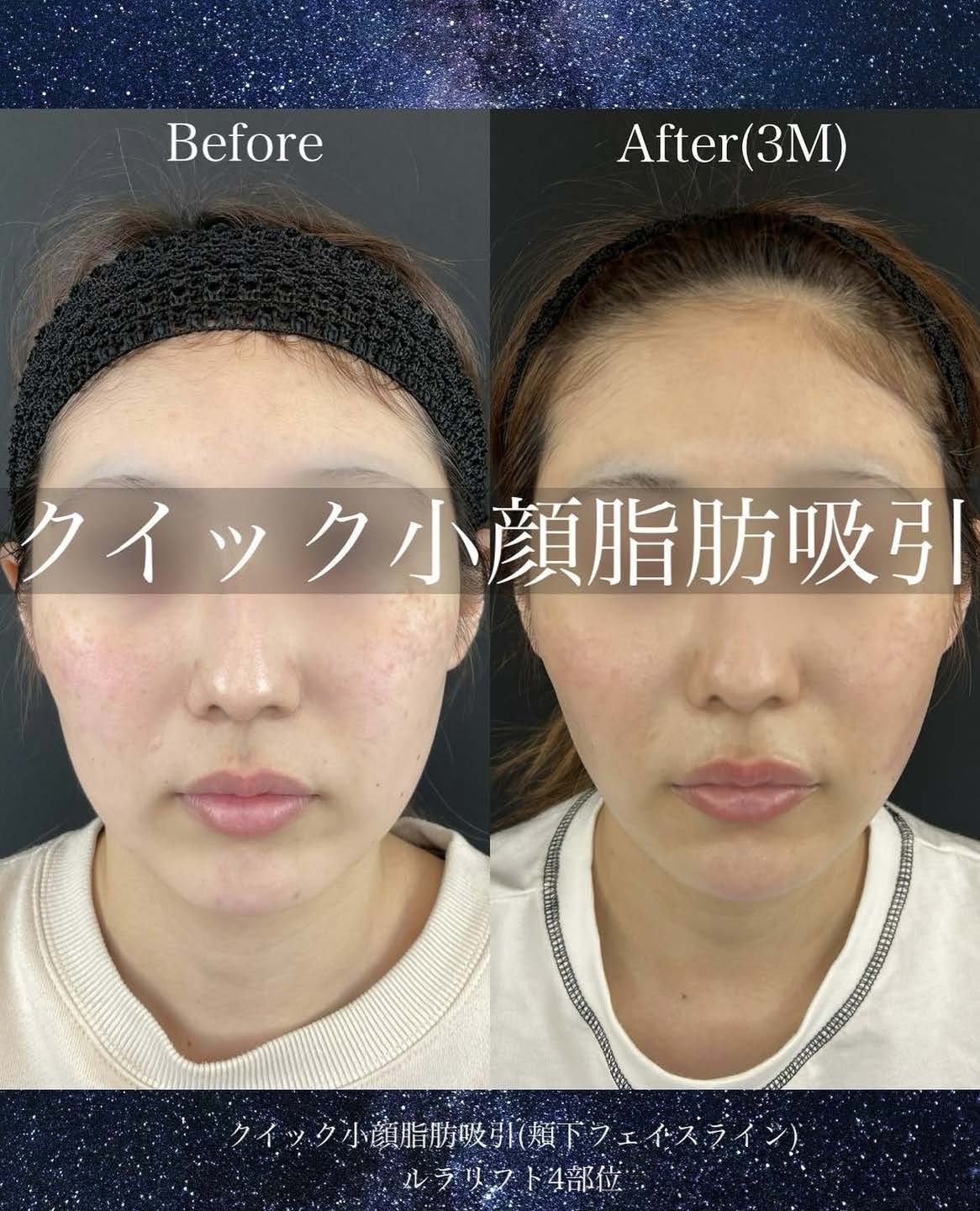 ルラ式クイック小顔脂肪吸引