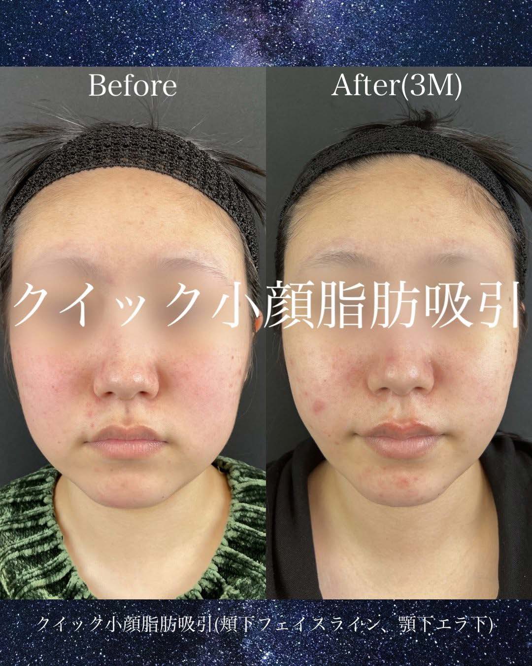 ルラ式クイック小顔脂肪吸引