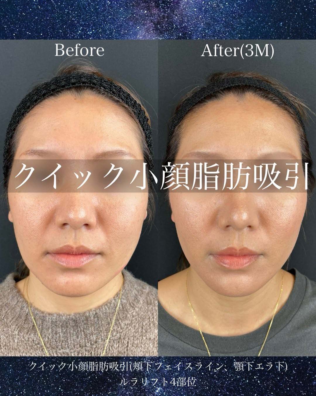 ルラ式クイック小顔脂肪吸引