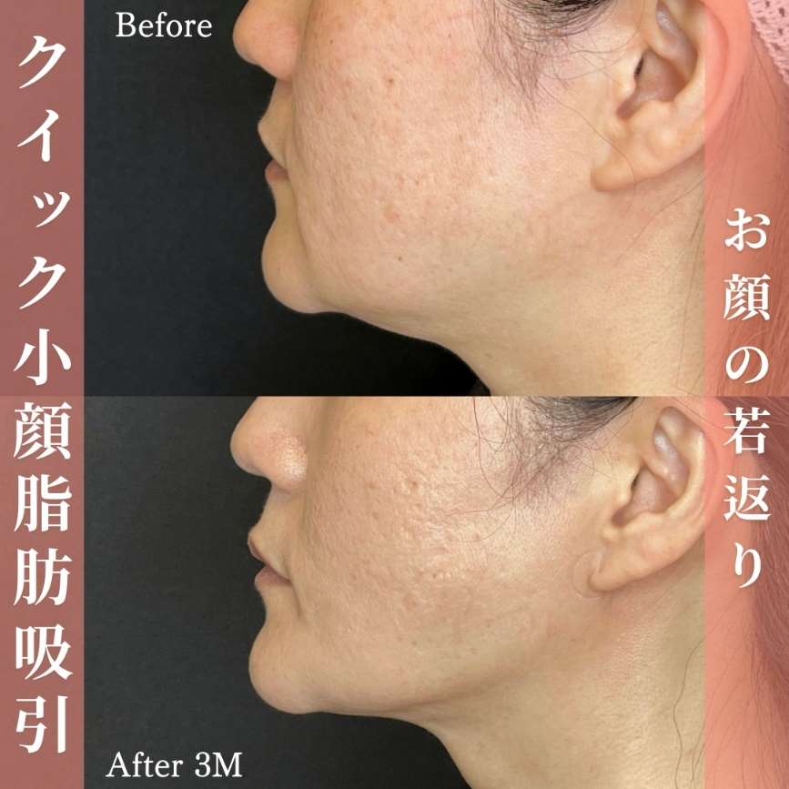 ルラ式クイック小顔脂肪吸引