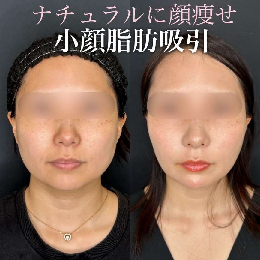 ルラ式クイック小顔脂肪吸引