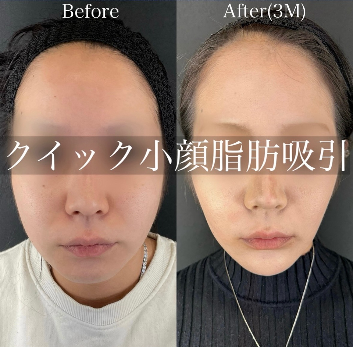 ルラ式クイック小顔脂肪吸引