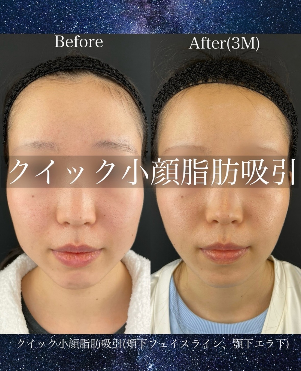ルラ式クイック小顔脂肪吸引