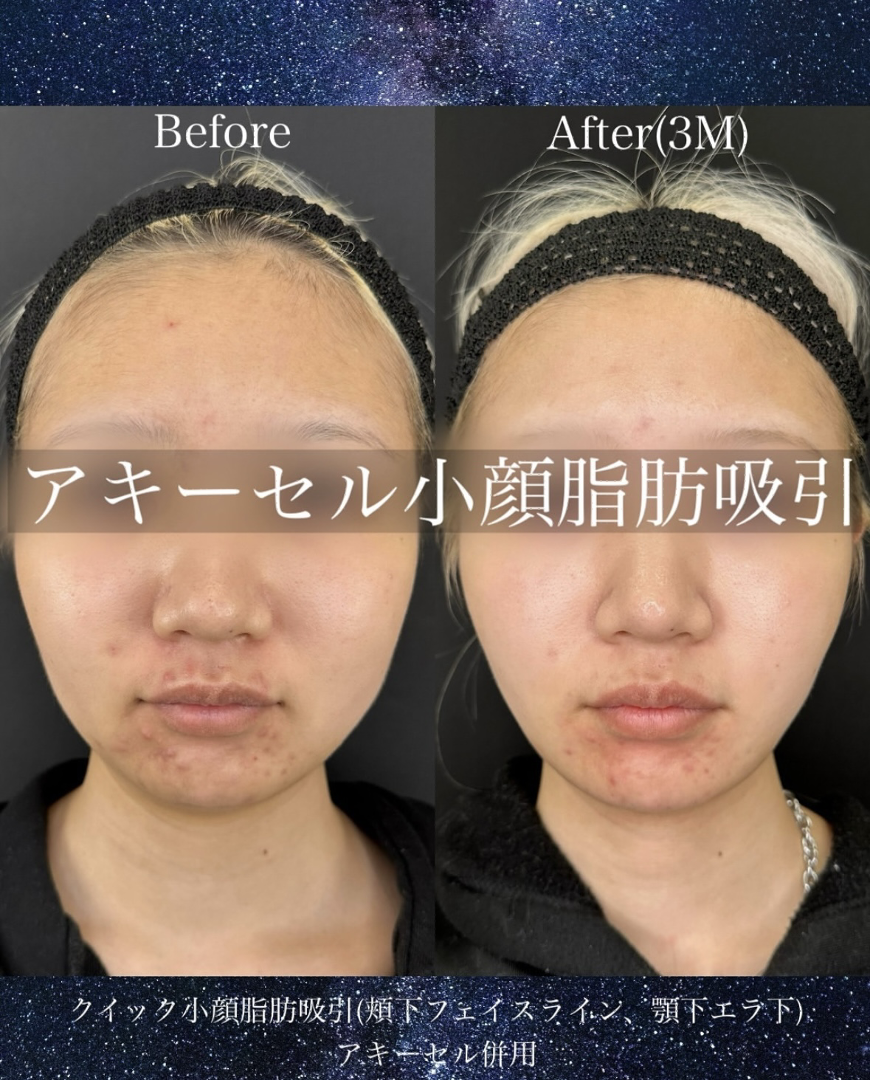 ルラ式クイック小顔脂肪吸引