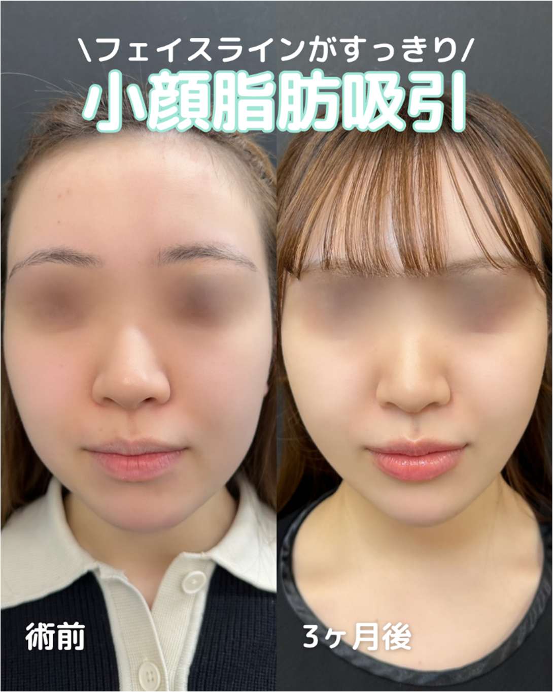 ルラ式クイック小顔脂肪吸引