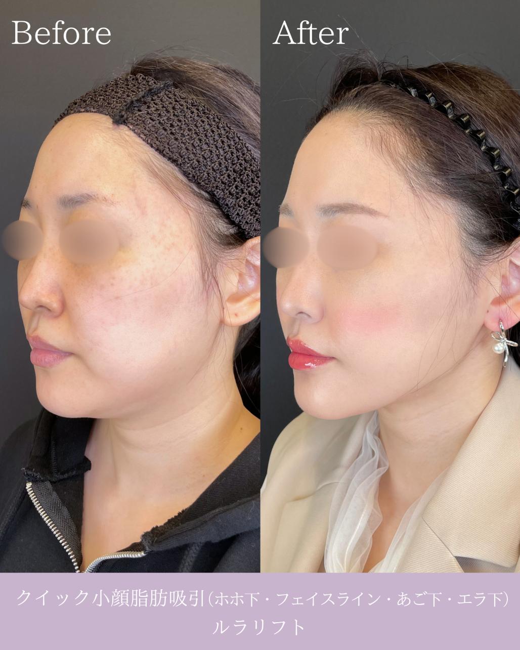 ルラ式クイック小顔脂肪吸引