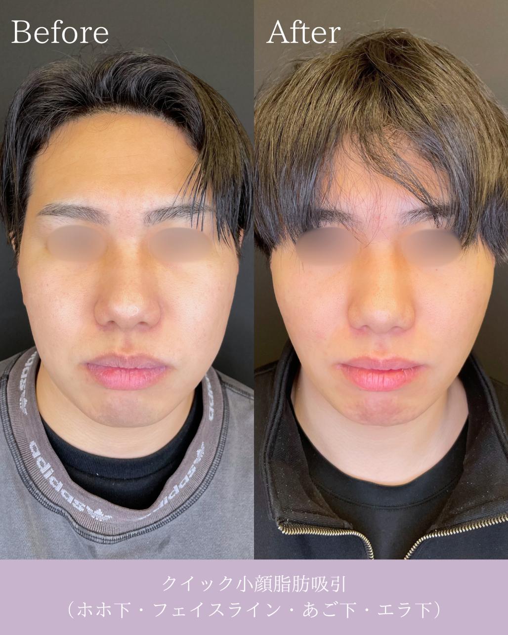 ルラ式クイック小顔脂肪吸引