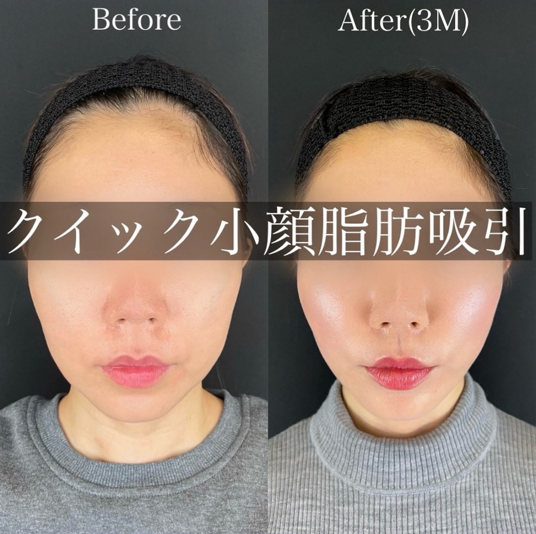 ルラ式クイック小顔脂肪吸引
