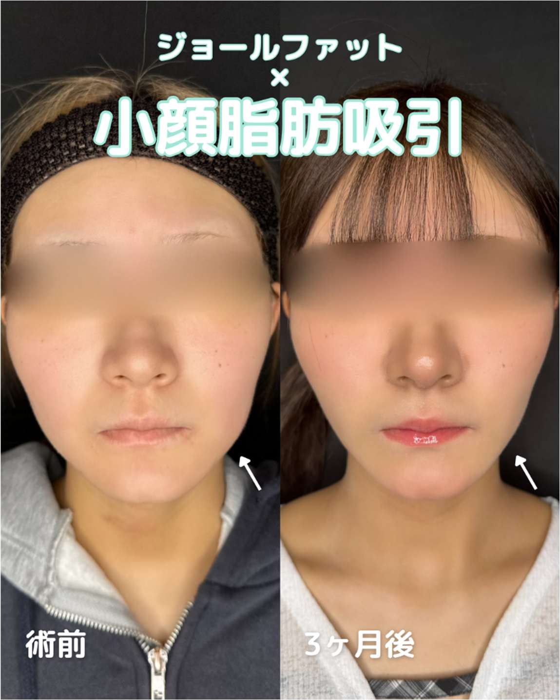 ルラ式クイック小顔脂肪吸引