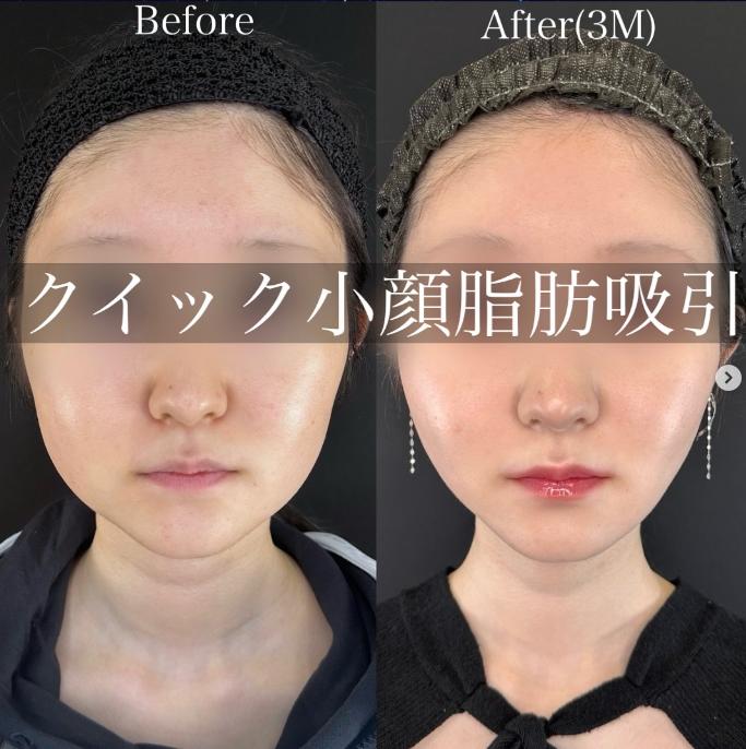 ルラ式クイック小顔脂肪吸引