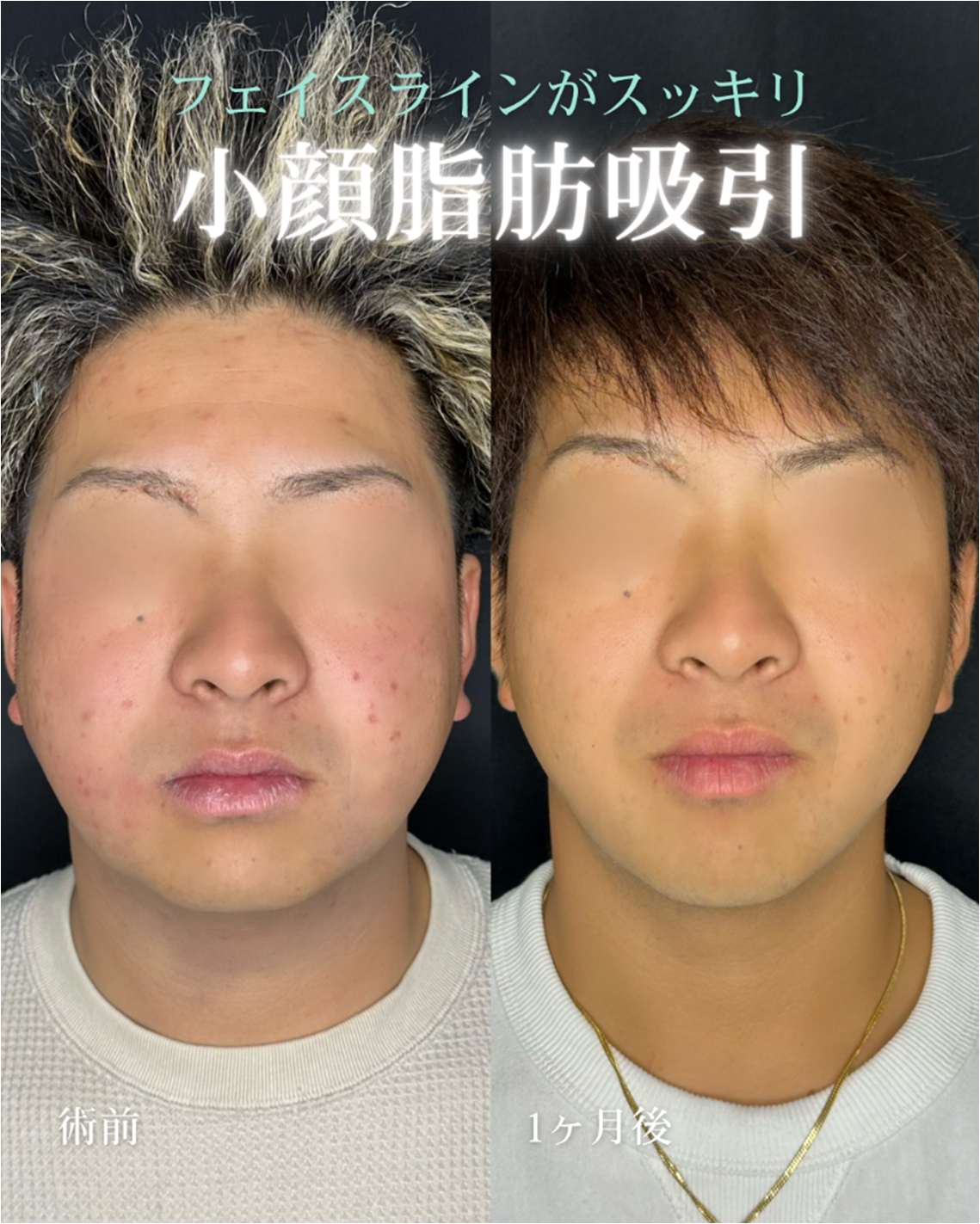 ルラ式クイック小顔脂肪吸引