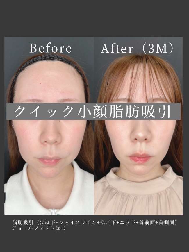 ルラ式クイック小顔脂肪吸引