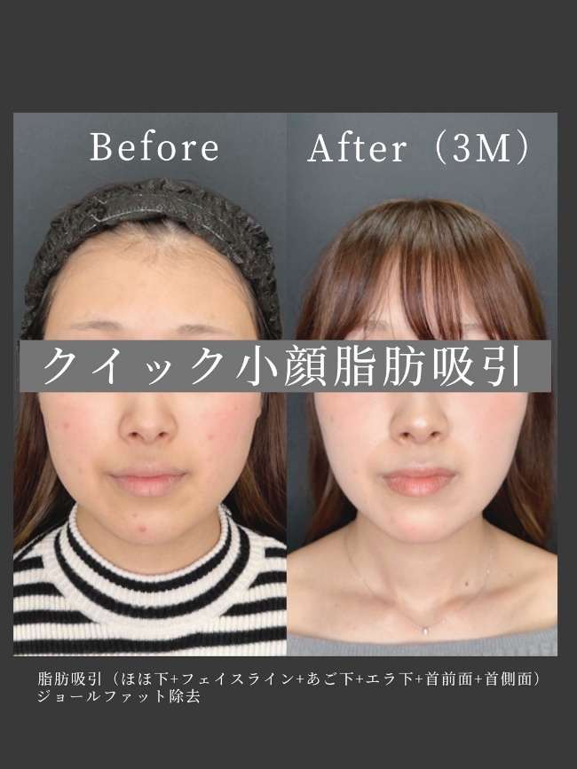 ルラ式クイック小顔脂肪吸引