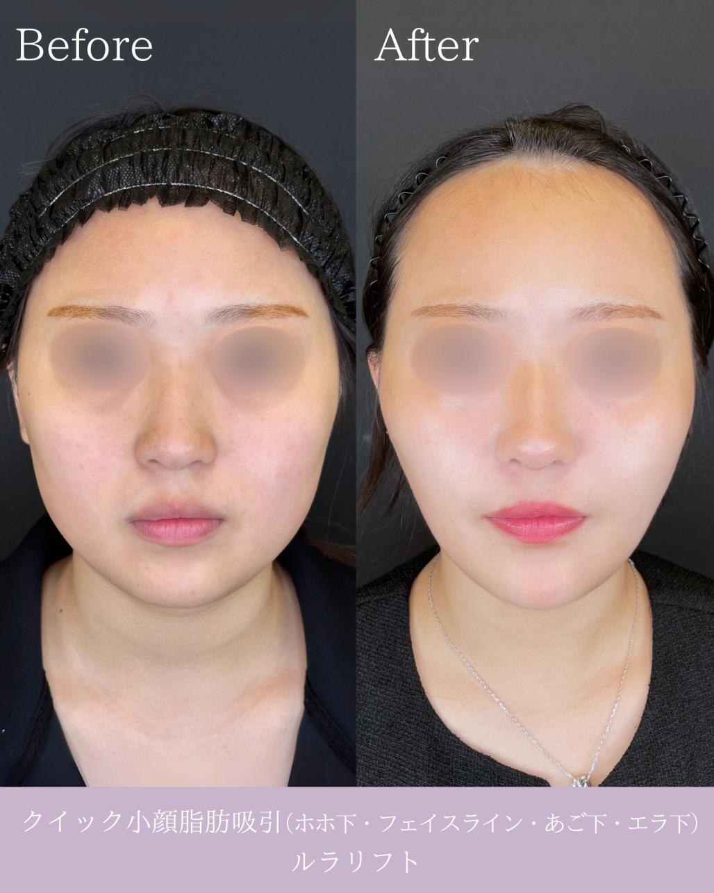 ルラ式クイック小顔脂肪吸引