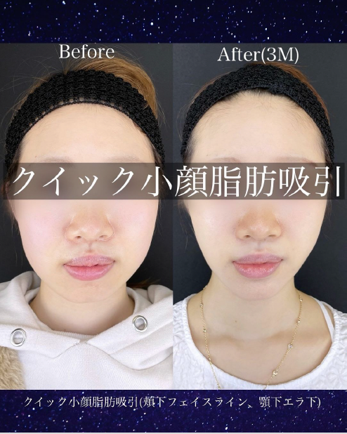 ルラ式クイック小顔脂肪吸引
