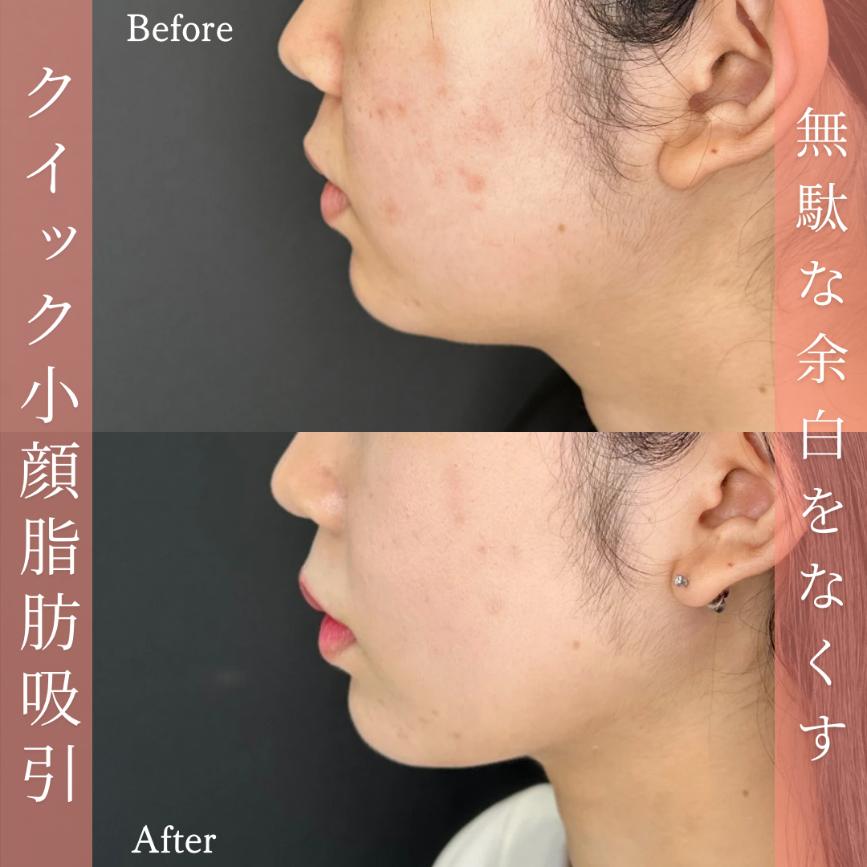 ルラ式クイック小顔脂肪吸引